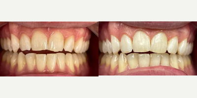 25-34 year old man treated with Dental Bonding - bonding