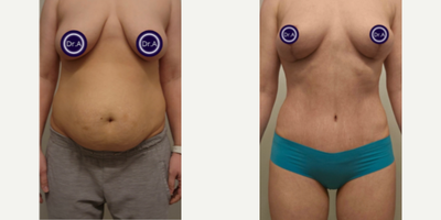 Woman treated with Mommy Makeover - Woman treated with Mommy Makeover through Breast Lift, Tummy Tuck with muscle repair, and Vaser Liposuction to the abdomen and flanks. Patient is shown before and a few months post-op.