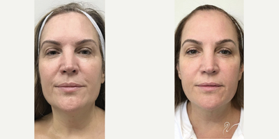 45-54 year old woman treated with Silhouette InstaLift - Silhouette InstaLift results
