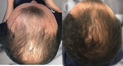 25-34 year old man treated with Mesotherapy - Patient underwentscalp mesotherapy. 