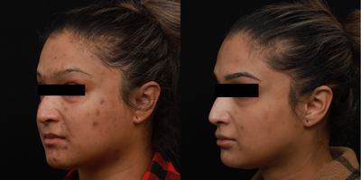 35-44 year old woman treated with Jessner Peel, Skin Rejuvenation - Patient treated for Adult Acne and Post Inflammmatory Hyperpigmenation due to acneic condition. The patient had a series of Q-Switched toning and peels to control acne and to even out the skin tone by reducing pigmented skin.