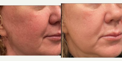 45-54 year old woman treated with IPL - 45-54 year old woman treated with IPL- Lumecca