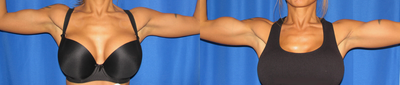 Woman treated with Bicep Implants - Woman treated with Bicep Implants