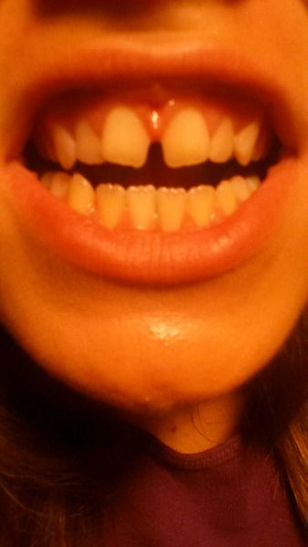 How should I get my teeth? I have a huge gap between them. Would braces ...