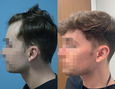 25-34 year old man treated with FUE Hair Transplant - Fue Hair Transplant - 2780 Grafts