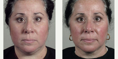 35-44 year old woman treated with Halo Laser after Ultherapy treatment. - This patient was interested in improving the overall appearance of her skin. She was concerned with areas of hyperpigmentation as well as the beginnings of a saggy neck. She was treated with Ultherapy followed by Halo two weeks later. The combined treatments increased the firmness of her skin and eliminated brown spots.&nbsp;