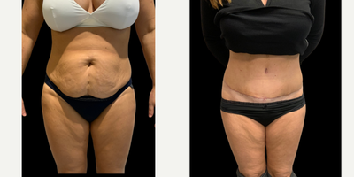 45-54 year old woman treated with Tummy Tuck - Abdominoplasty with removal of vertical scar .