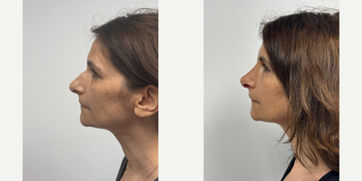 Woman treated with Rhinoplasty - Woman treated with Rhinoplasty.