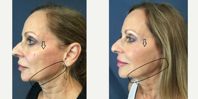 55-64 year old woman treated with Thread Lift - Patient tread with Threadlift