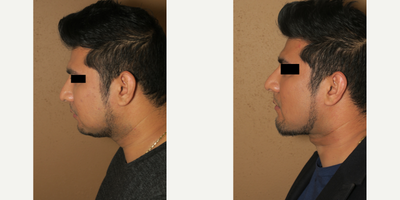 35-44 year old man treated with Buccal Fat Removal - Buccal fat pad removal, lipo of the neck and chin augmentation.