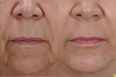 Fractional Resurfacing - This patient had lines around the mouth that were bothering her. I used the profractional laser from Sciton to resurface around the mouth.