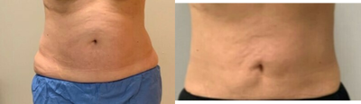 65-74 year old woman treated with Emsculpt - Full abdomen and flanks