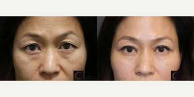 Yag Laser Treatment - Eyelid surgery with filler and laser treatments.