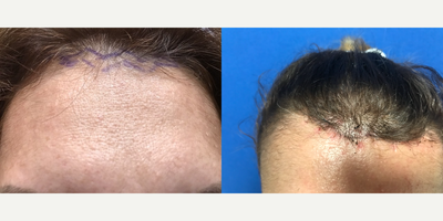47 year old woman treated with Open Forehead lift - This patient wanted brow lift and correction of brow asymmetry as well as reduction of tall forehead. An open approach with incision placed in zig-zag fashion along the hairline was used, 2 cm of skin was removed to lower the forehead hight. Patient is shown before, immediately after and 1.5 y after forehead lowering/brow lift surgery with open approach.