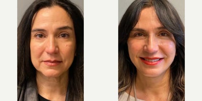 Woman treated with Facelift - Woman treated with Facelift and Neck Lift