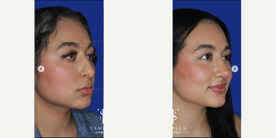 Woman treated with Rhinoplasty - Woman treated with Rhinoplasty