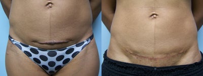 Keloid scar excision and revision - 
	Post operative photo taken 6 weeks after scar removal
