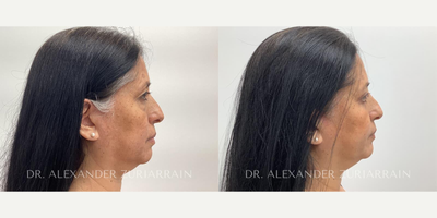 55-64 year old woman treated with Eyelid Surgery - 55-64 year old woman treated with Eyelid Surgery- 1 month post-op