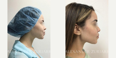 25-34 year old woman treated with Buccal Fat Removal - 25-34 year old woman treated with Buccal Fat Removal- 8 months post-op