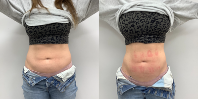 55-64 year old woman treated with Evolve - Evolve Trim is a minimally invasive treatment used to destroy fat cells and target large areas of fat. Evolve Tite is used to reduce the appearance of cellulite and tighten skin.
