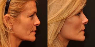 Woman treated with Fat Transfer - Fat Transfer