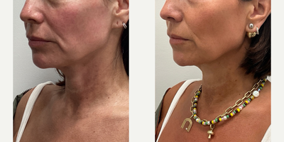 Sofwave: Full face and neck - This wonderful patient had Sofwave full face and neck and the after is shown at 4 months.