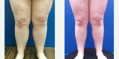 18-24 year old woman treated with Calf Reduction - 24-year-old lady underwent Power & Laser-assisted Liposuction of the Calves, Ankles & Lateral Feet.