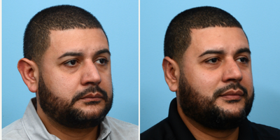 35-44 year old man treated with Earfold - This 36-year-old patient had an otoplasty, commonly referred to as ear pinning surgery, in order to reduce the size and projection of his ears. 10 weeks post-op the patient is happy to see such a huge improvement in his overall appearance and feels much more confident wearing his hair short.