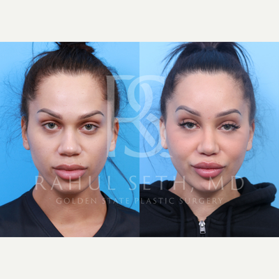 18-24 year old transgender woman treated with Adam's Apple Reduction, Facial Feminization Surgery, Transgender Facial Feminizati - Comprehensive facial feminization surgery provides beautiful, natural results. An approach to address all areas of the face in a harmonious way is done with surgery to the brows, forehead, orbits/eyes, nose, cheeks, jaw, chin, neck, and Adam's apple. The Adam's apple is reduced WITHOUT A SCAR using Dr. Seth's scarless tracheal shave procedure, a procedure he created.