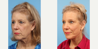 64 year old woman treated with Brow Lift - A 64 year-old woman before and after Cheek and Neck Lift w/Anterior Platysmaplasty, Quad Blepharoplasty, and Endoscopic Brow Lift by Andrew T. Lyos M.D., FACS.