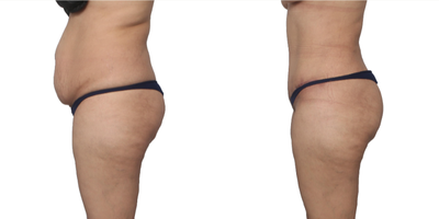 Woman treated with Smart Lipo - This 36-year-old mom was done having children and wanted her potbelly gone, her waistline snatched, and her booty fuller. She was treated with lipo 360 - abdomen, flanks, and back, fat transfer to the hips and buttocks, and a tummy tuck with muscle plication, diastasis repair, and a scarless belly button. Back to work in 3 weeks and super happy.