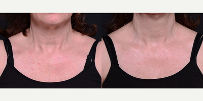 Woman treated with Aquagold - Woman treated with Aquagold