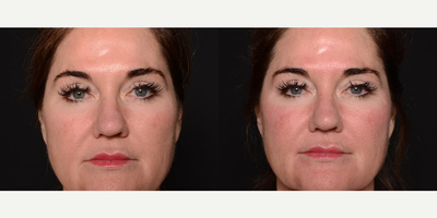 Woman treated with Aquagold - Woman treated with Aquagold