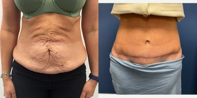 39 year old treated with abdominoplasty - Full abdominoplasty including rectus plication (repair of rectus diastasis) and loin liposuction.