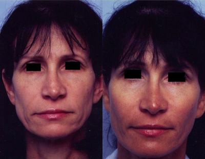 Cheek implants - Before and after cheek implants