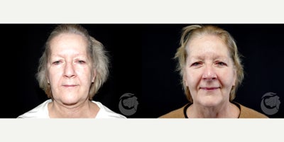 64 year old woman treated with Thread Lift to lower face. - 64 year old woman treated with Thread Lift to lower face. Photos depict before and 2 months after Silhouette Instalift sutures.