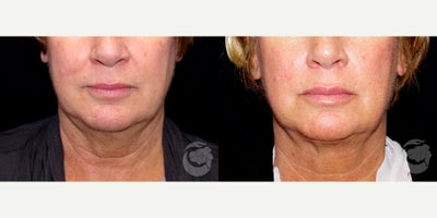 57 year old woman treated with CoolMini to chin. - 57 year old woman treated with CoolMini to chin. Photos depict before and 3 months after treatment.