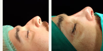 25-34 year old man treated with Rhinoplasty - travmatic nose male rhinoplastypreservation rhinoplastyclosed approachno cast