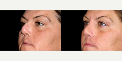 43 year old woman treated with Cleft Lip And Cleft Lip Revision. - 43 year old woman treated with Cleft Lip And Cleft Lip Revision. Photos depict before and 9 months after surgery.
