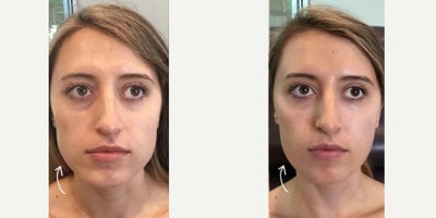 25-34 year old woman treated with Botox for TMJ - Botox for TMJ (the temporomandibular joint) Done by: Cynthia, RN