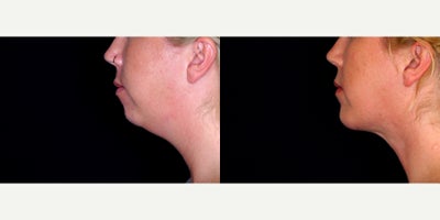 27 year old woman treated with Genioplasty and submental necklift - 27 year old woman treated with Genioplasty and submental necklift. Photos depict before and 3 months after surgery.