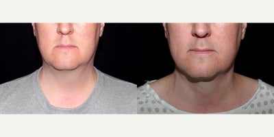 40 year old man treated with PrecisionTx - 40 year old man treated with PrecisionTx. Photos depict before and 3 months after surgery.