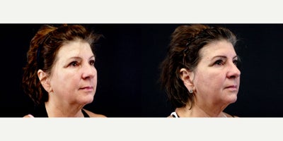 57 year old woman treated with Thread Lift - 57 year old woman treated with Thread Lift. Photos depict before and 1 month after 8 Silhouette Instalift Sutures.