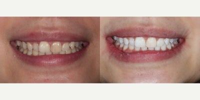 25-34 year old woman treated with KoR Teeth Whitening - KoR Teeth whitening