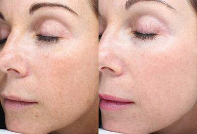 35-44 year old woman treated with Halo Laser - Before and after one treatment HALO