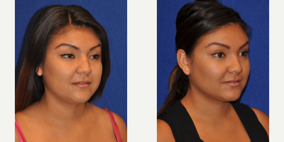 Buccal Fat Removal - Buccal Fat Removal