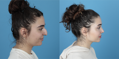 18-24 year old woman treated with Rhinoplasty - 18 years old female, 8 months after her Rhinoplasty, she is very happy with the results