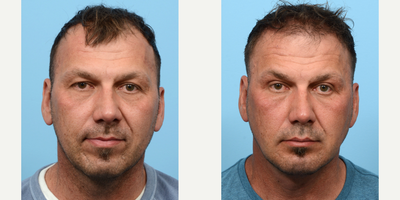 45-54 year old man treated with Neck Lift, Chin Implant - Looking to improve the appearance of his lower face and neck, this 51-year-old came to Dr. Wise for a Deep Neck Lift and Chin Augmentation. Combining these procedures allowed for exclusive focus on the lower half of his face, helping contribute to an overall balanced and harmonious facial profile.