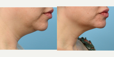 35-44 year old woman treated with CoolMini, CoolSculpting - Looking to permanently remove fat from underneath her chin, this patient came to Wise Med Spa for CoolMini. 2 months after her treatment she loves her side profile.