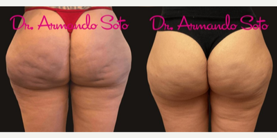 36 year old woman treated with Qwo - This 36 year old patient wished to have less dimpling on her buttocks. This is the outcome achieved through Qwo. She is shown before and one month after her first of 2-3 Qwo treatments, and her outcome will only get better.